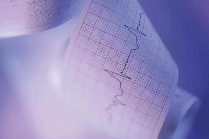 ECG TRACINGS